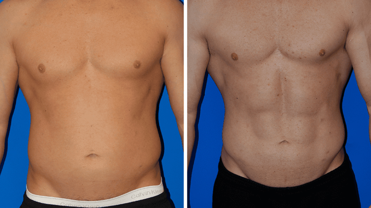 The best surgeons for you to have a Liposuction (ดูดไขมัน) you will know on this site.